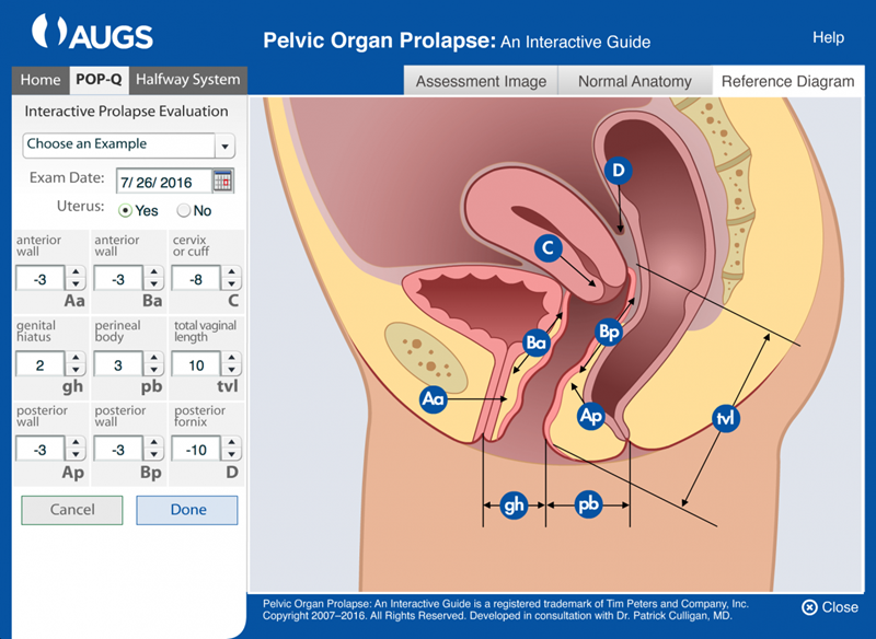 Pelvic Organ Prolapse Patient Education Poster — APOPS