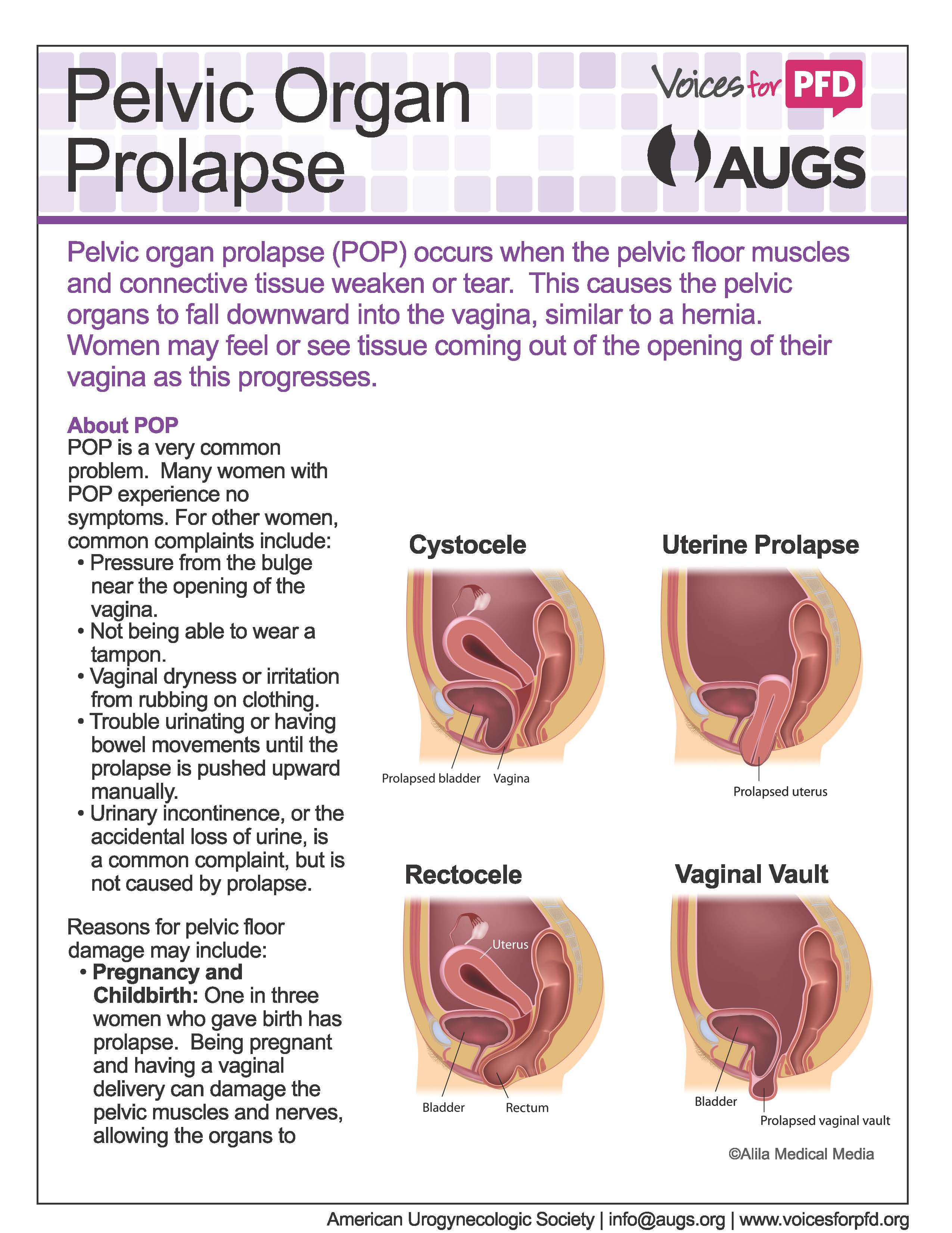 Different Types Of Pelvic Organ Prolapse In Pelvic Organ Hot Sex Picture